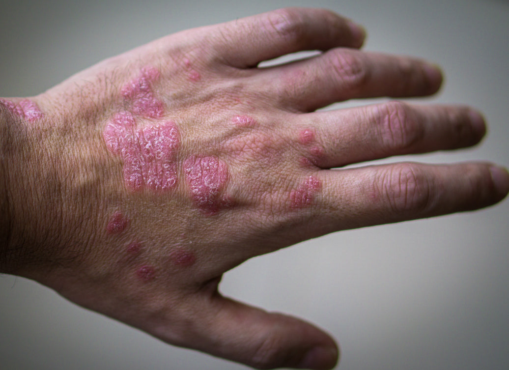 How Serious Is Psoriasis? Balmonds