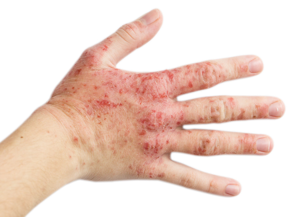 What’s The Main Cause Of Eczema? Balmonds