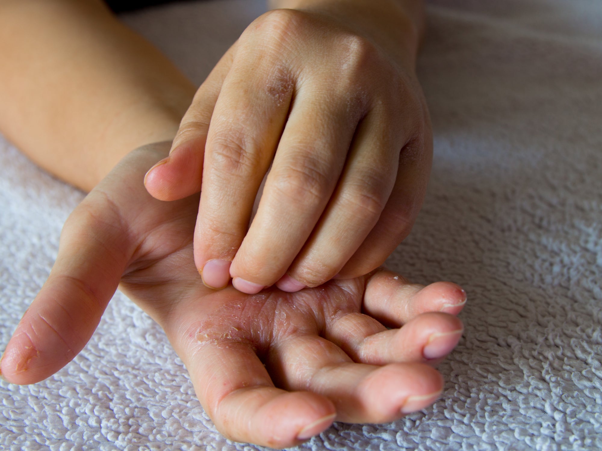 can-hand-sanitiser-make-your-hands-itch-balmonds