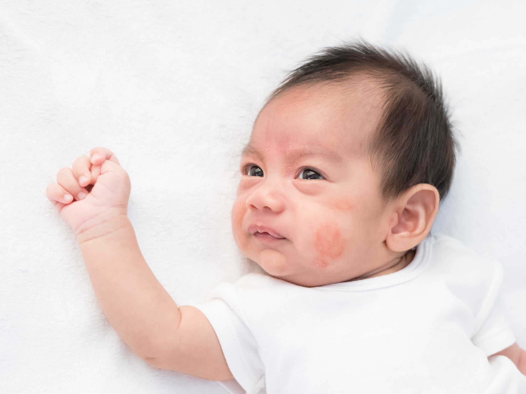 What Foods Trigger Eczema In Babies? Balmonds