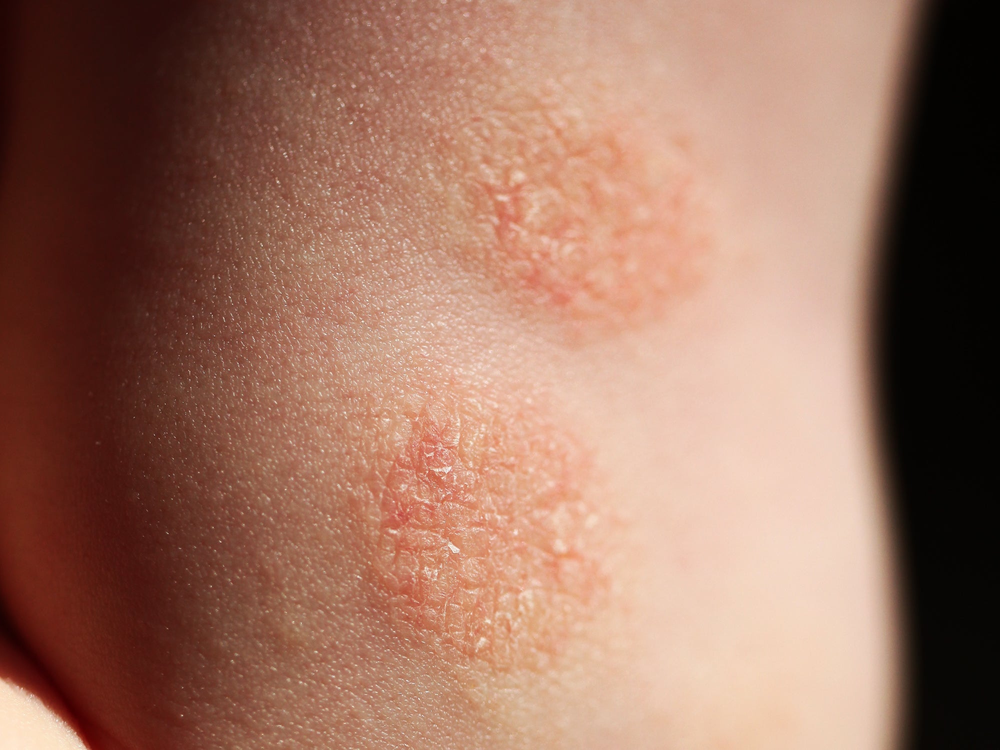 How Do You Get Rid Of Nummular Eczema? Balmonds
