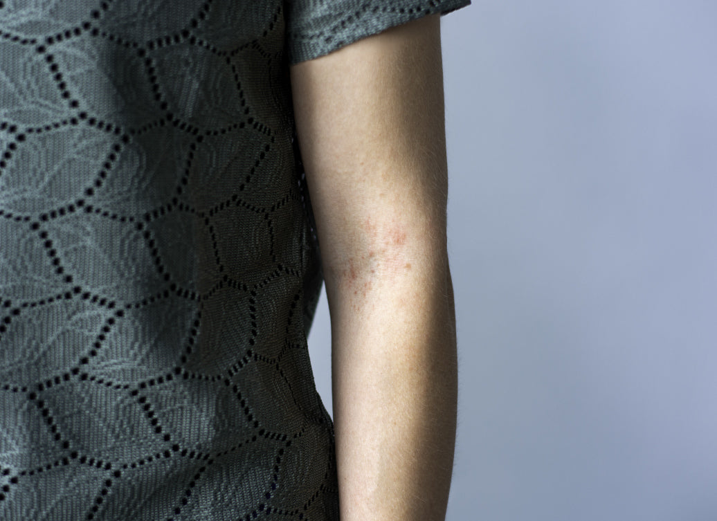 Polymorphic Light Eruption on arm