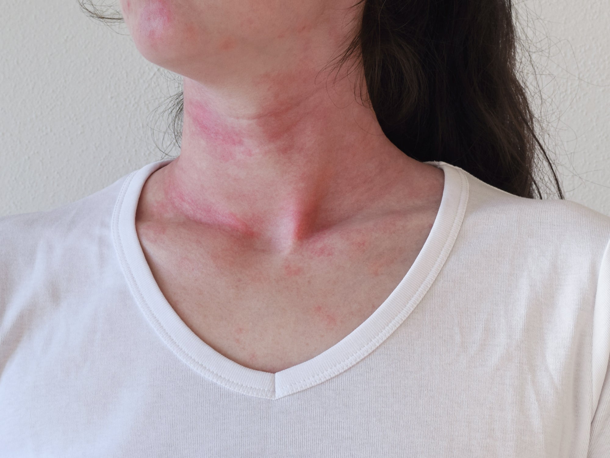 Identifying Triggers For Eczema FlareUps And Skin Sensitivities Balmonds