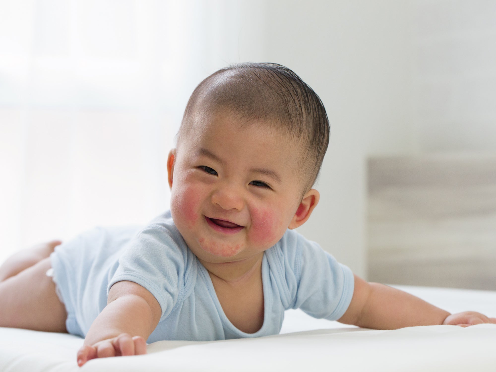 How To Wet Wrap A Baby With Eczema Balmonds