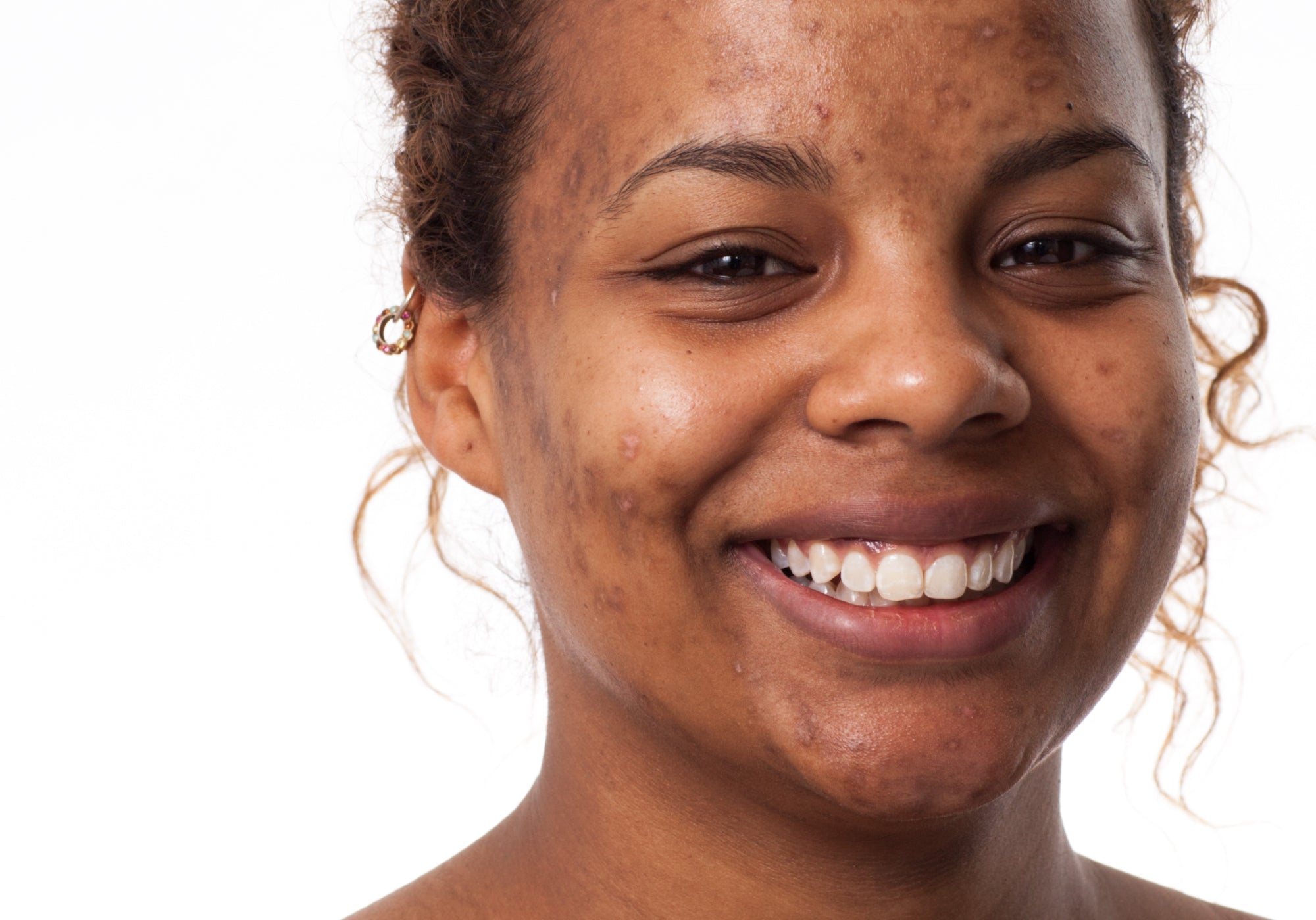 How To Get Rid Of Post-Inflammatory Hyperpigmentation