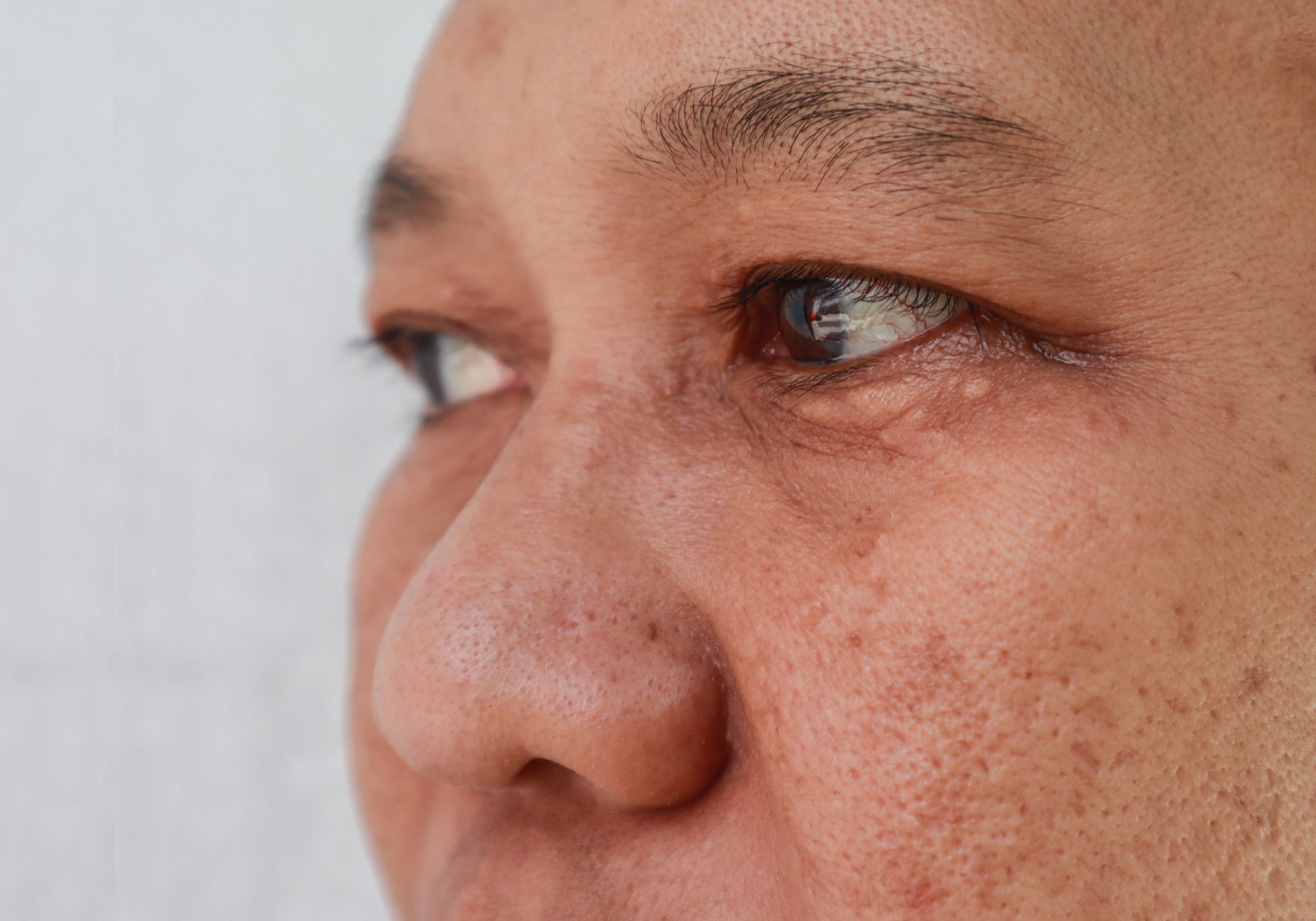 What Is Post-Inflammatory Hyperpigmentation?