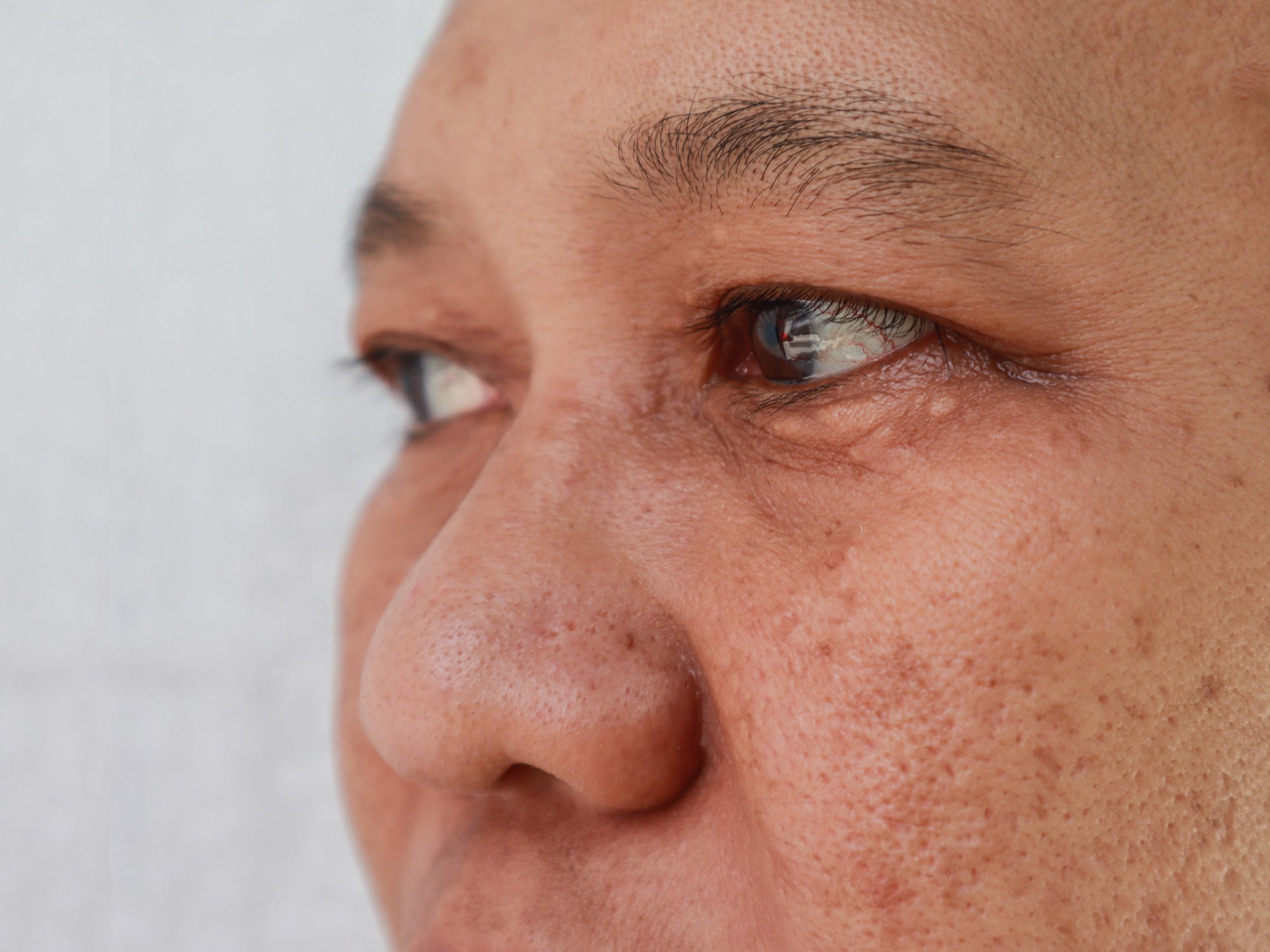 What Is Post-Inflammatory Hyperpigmentation?