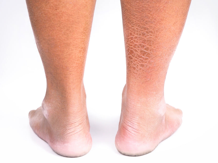 What Part Of The Skin Is Affected By Ichthyosis?