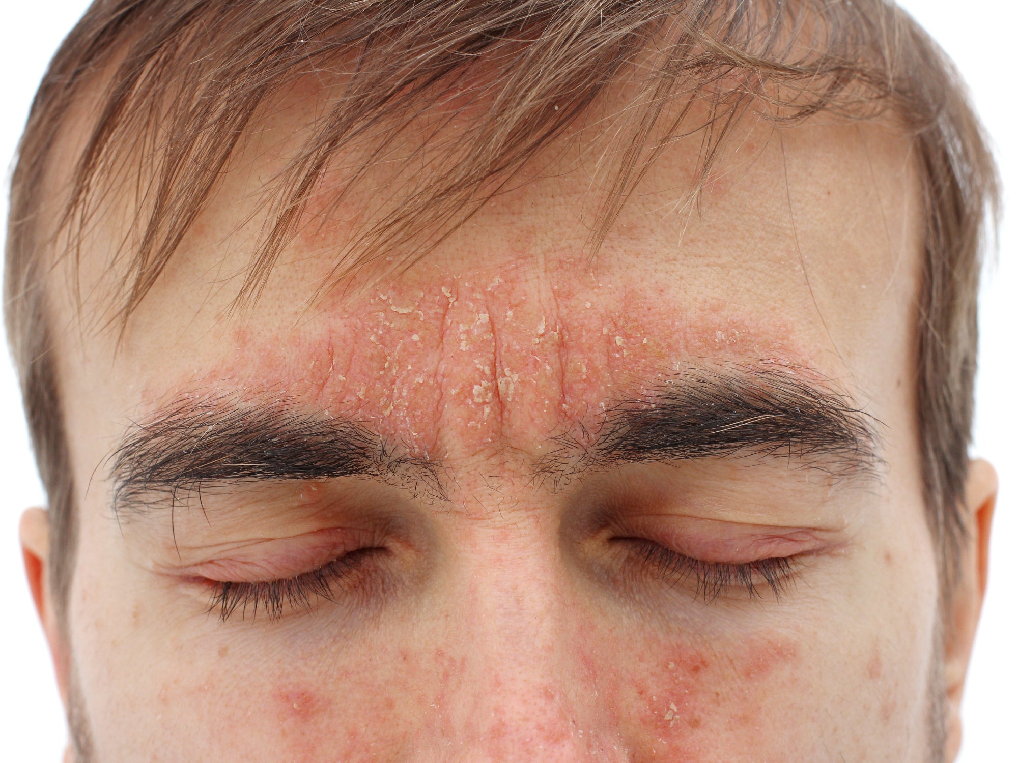 Eczema On Eyebrows Eczema On Eyebrows