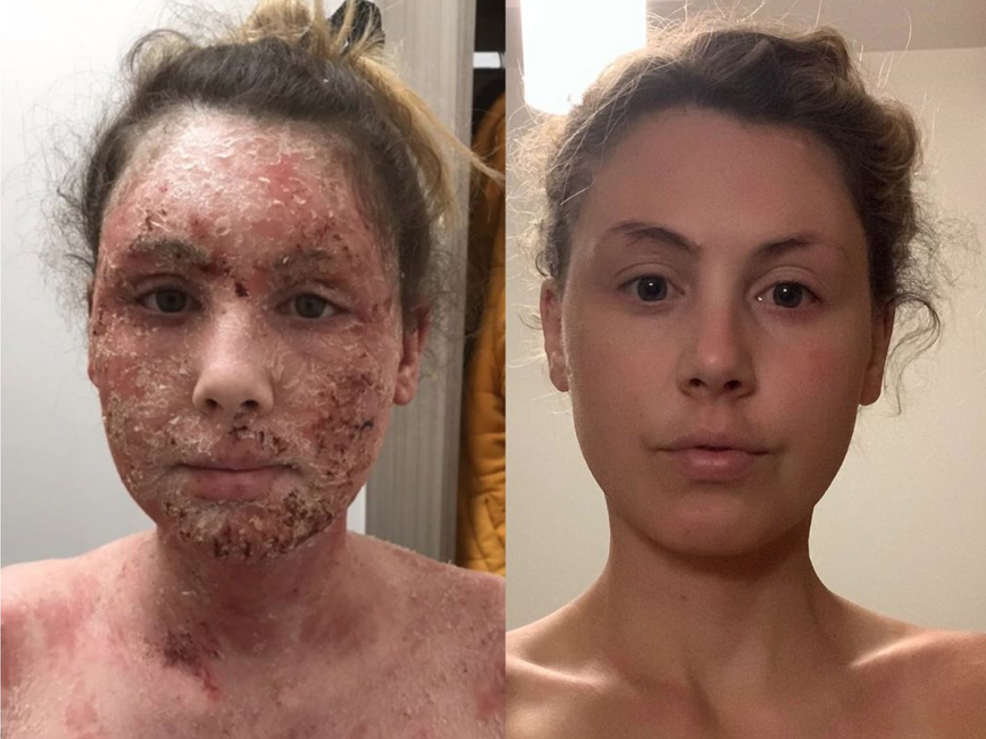 How To Get Through Topical Steroid Withdrawl (TSW): High Pulse 