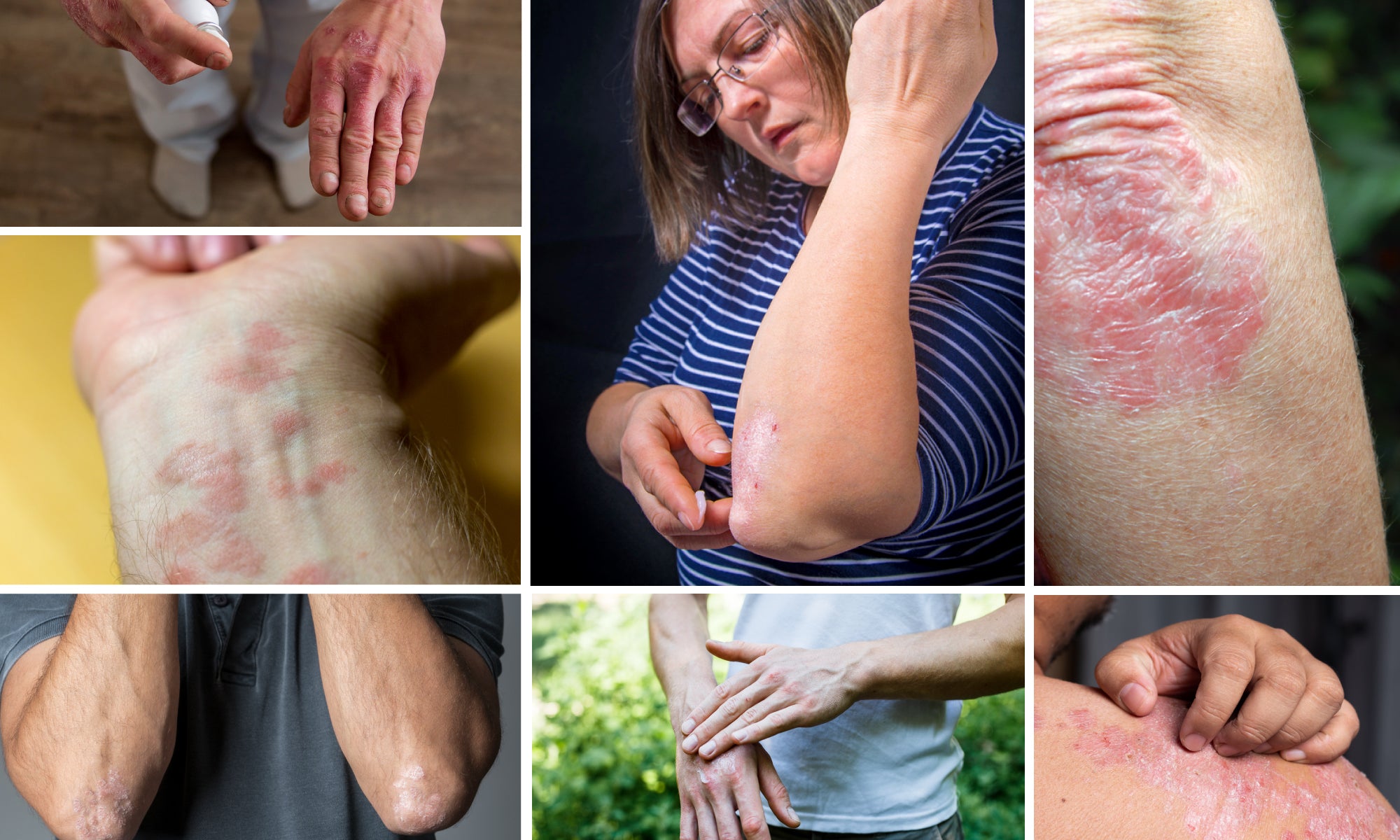 7 Types Of Psoriasis: Symptoms and Pictures