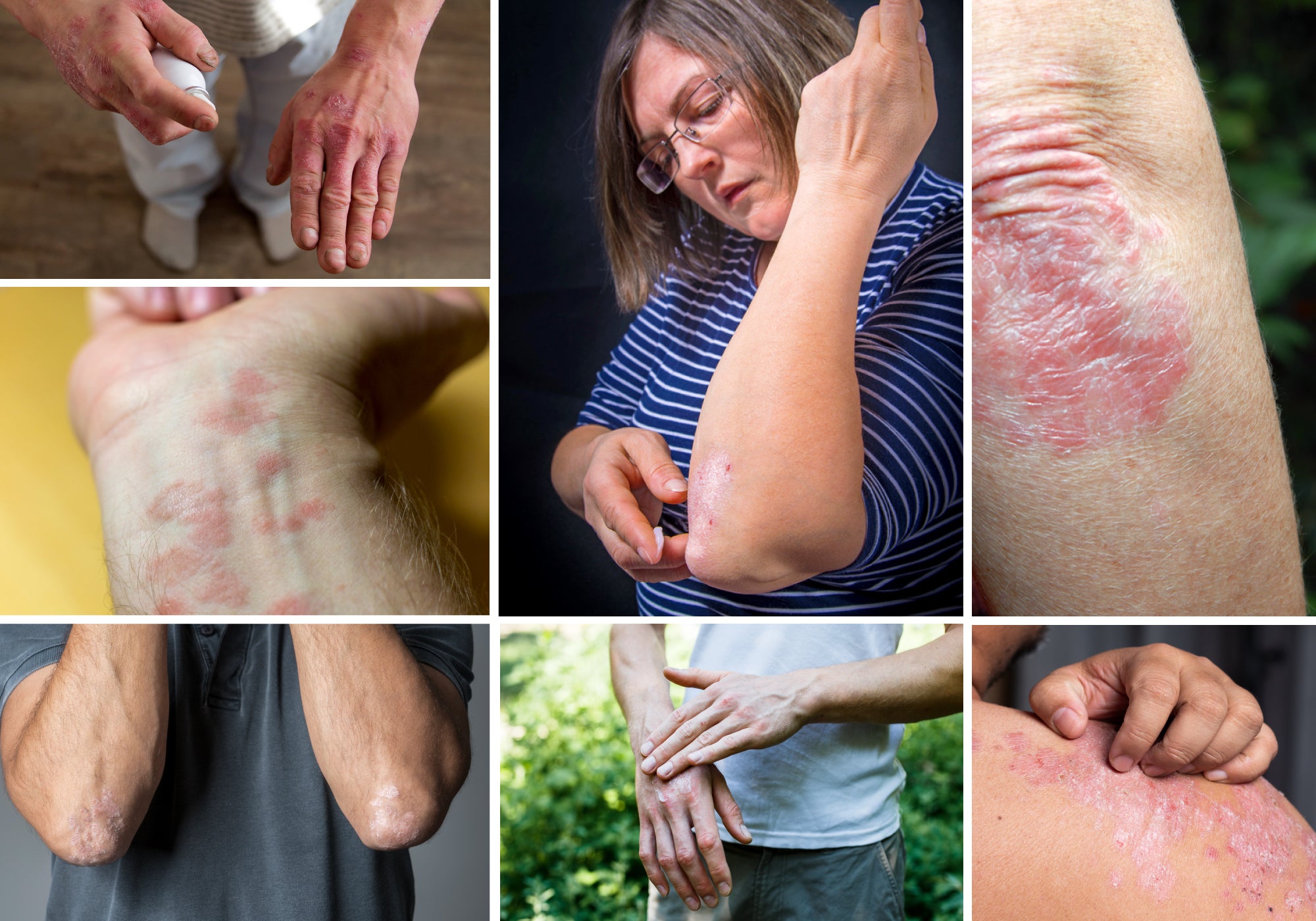 7 Types Of Psoriasis: Symptoms and Pictures
