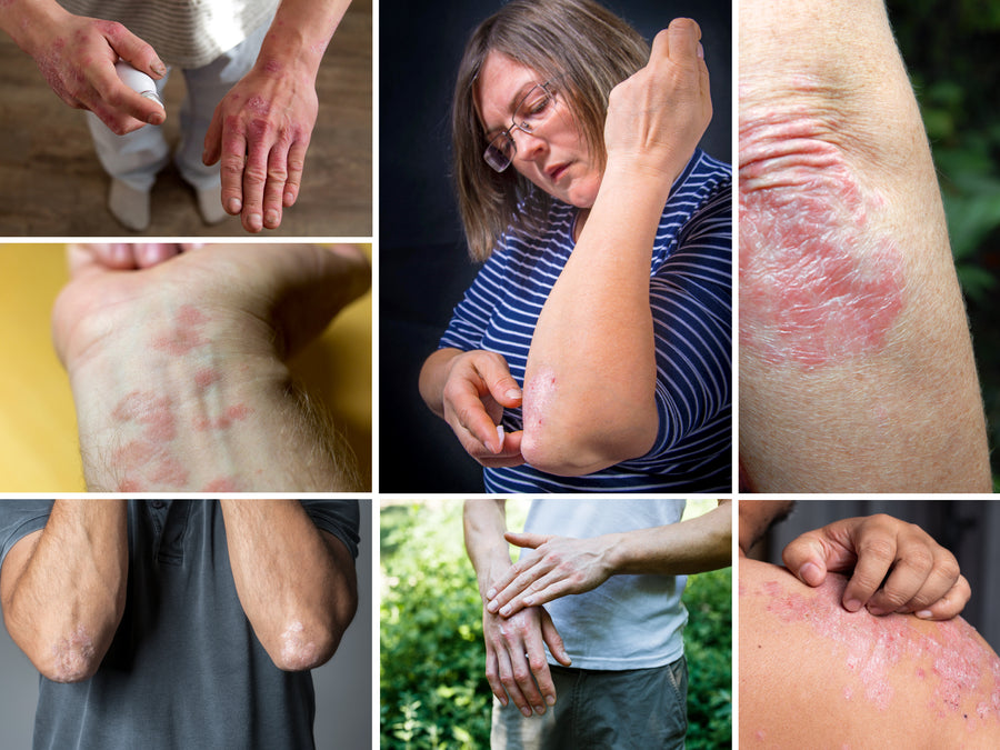 7 Types Of Psoriasis: Symptoms and Pictures