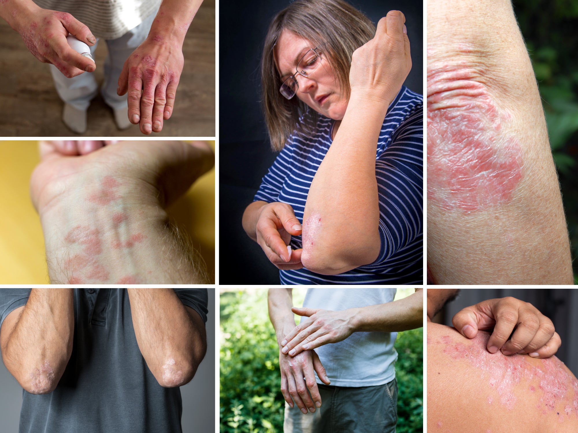7 Types Of Psoriasis: Symptoms and Pictures