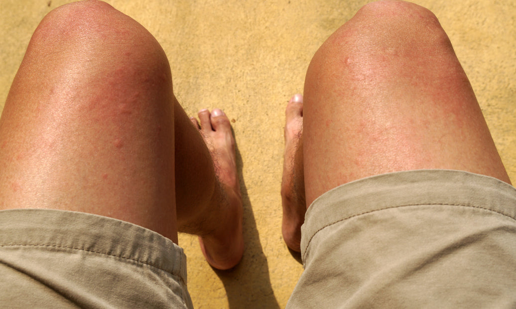 Does Chlorine Rash Spread?