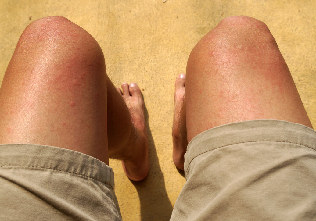 Does Chlorine Rash Spread?