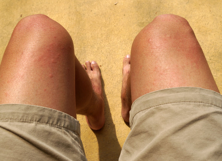 How Long Does it Take for Chlorine Rash to Go Away? – Balmonds
