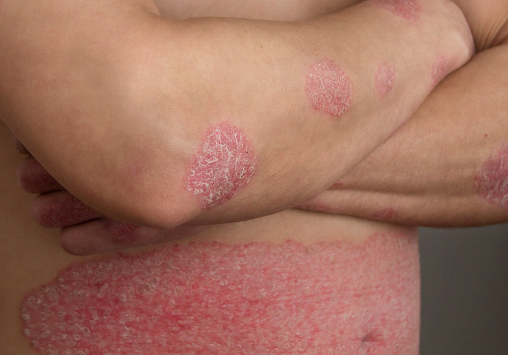 Does Psoriasis Have A Smell?