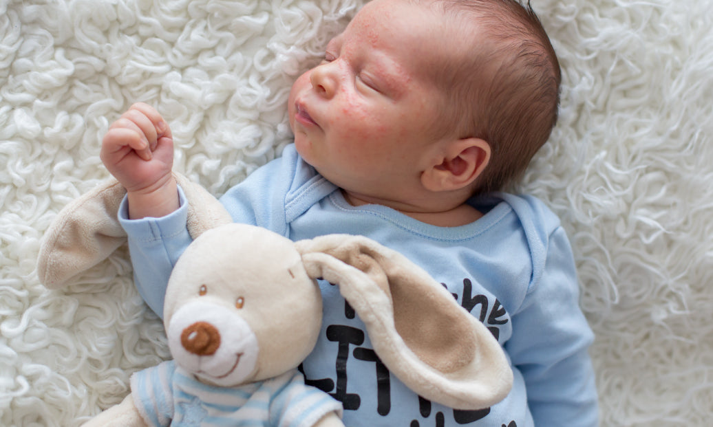 A baby with eczema on cheeks