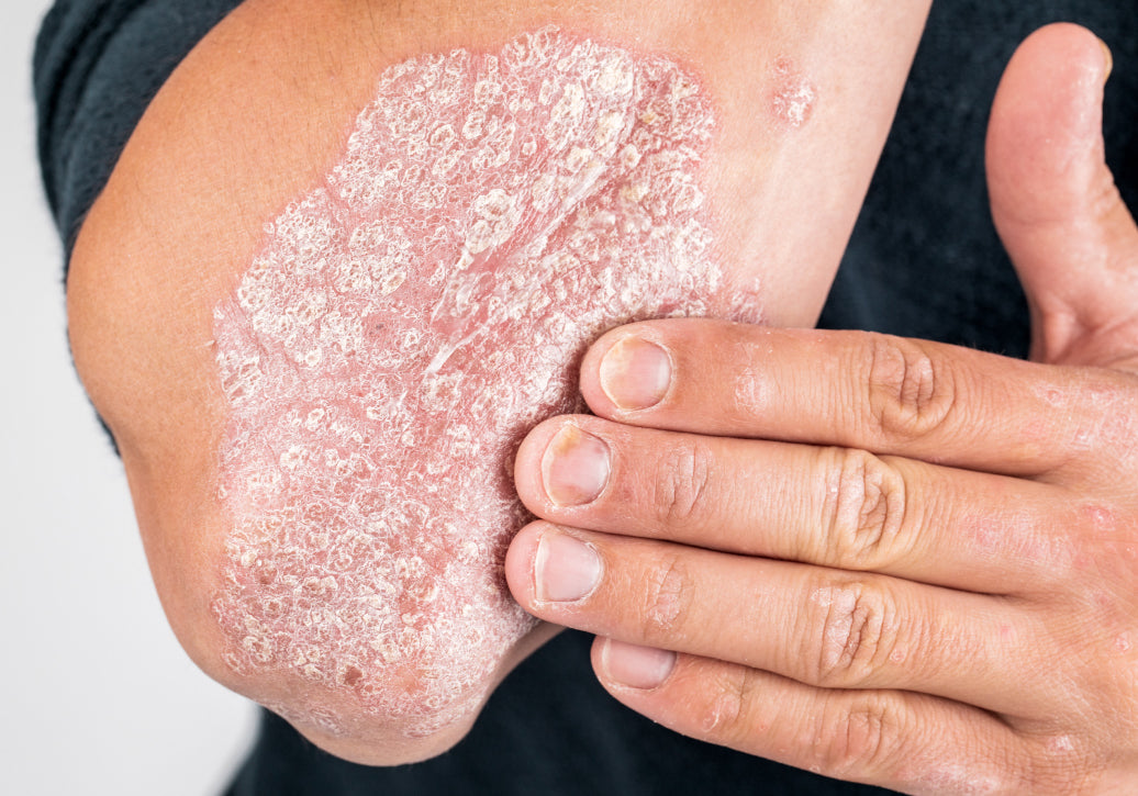 How Do You Clear Up Psoriasis?