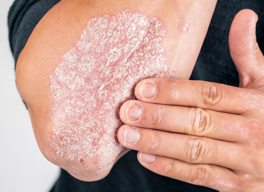 How Do You Clear Up Psoriasis?