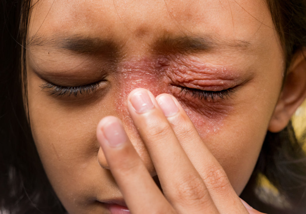 How Do You Treat Periocular Dermatitis?