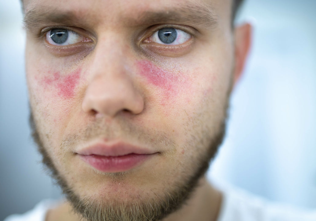 Is Rosacea A Sign Of Lupus?