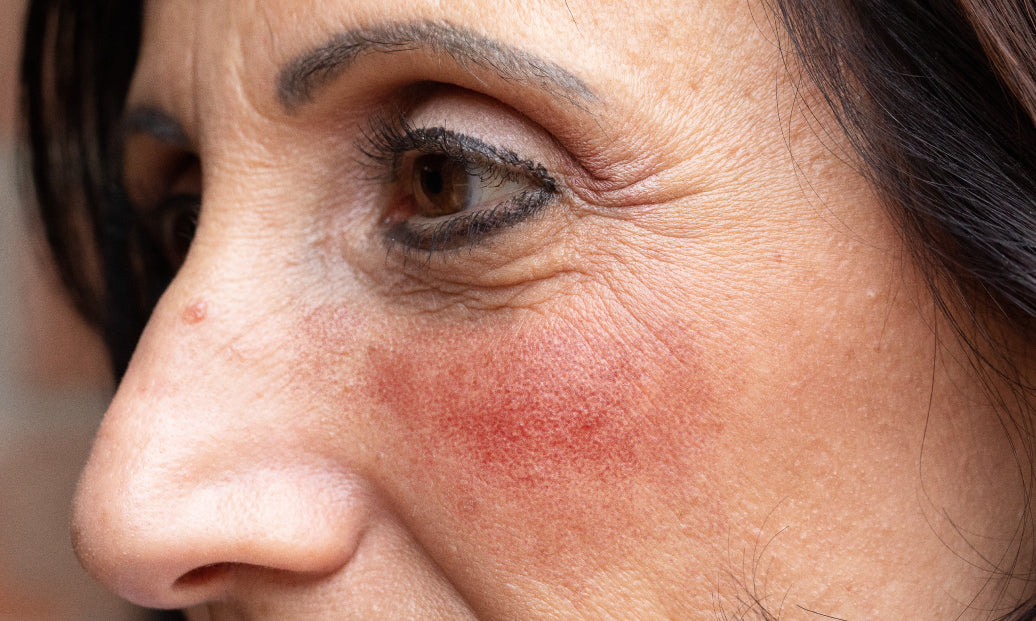 Is Rosacea Hormone Related?