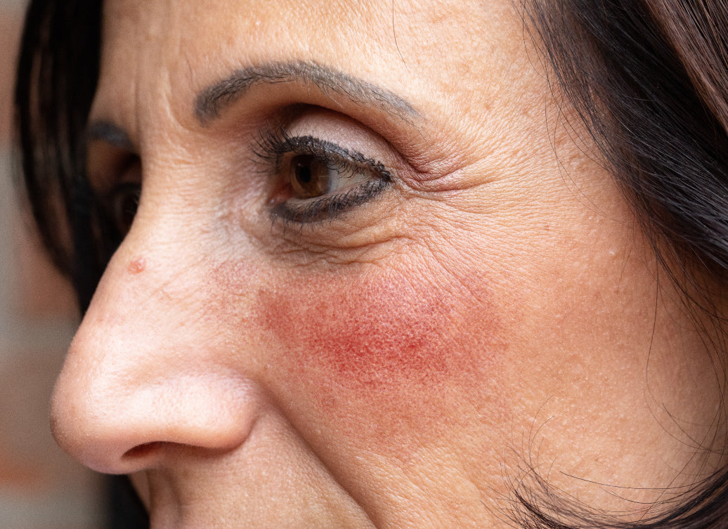 Is Rosacea Hormone Related?