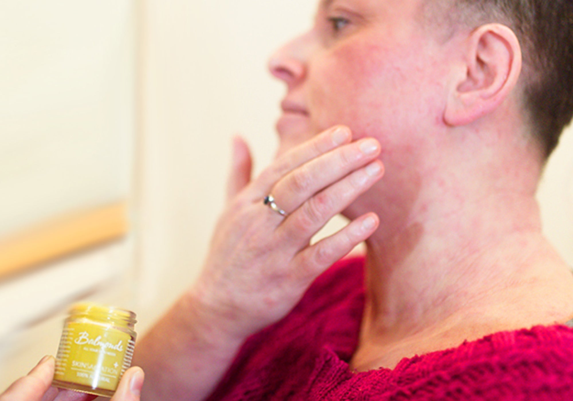 What’s The Best Treatment For The Face In Topical Steroid Withdrawal?