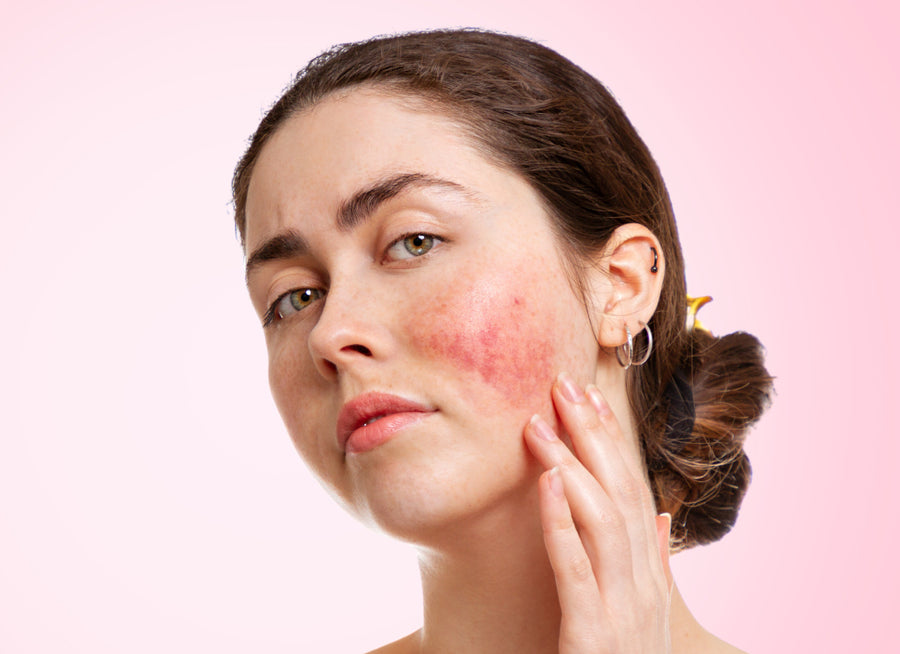 What Are The Stages of Rosacea?