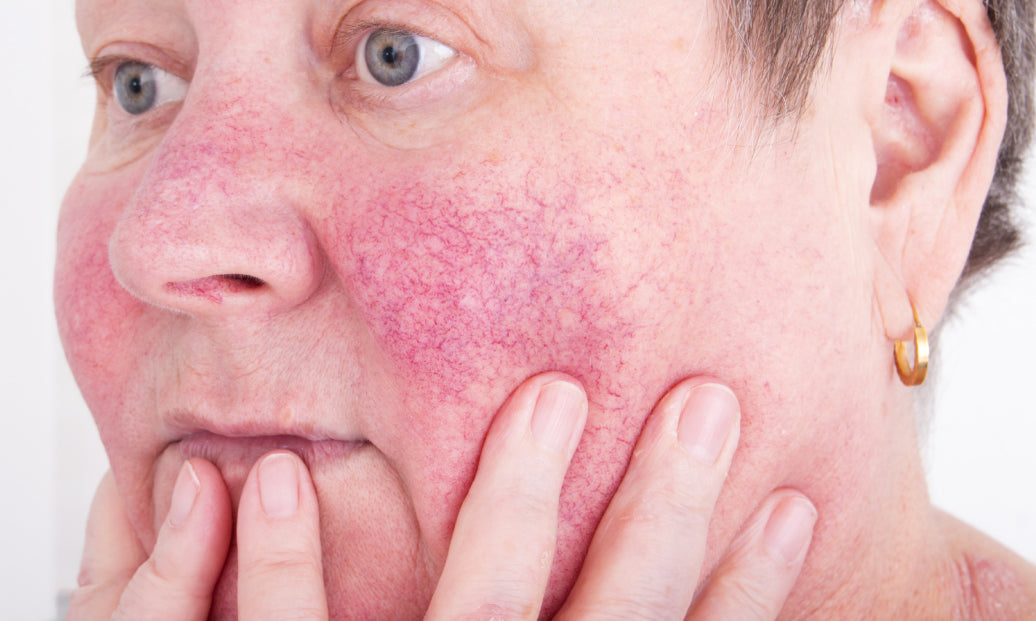 What Causes Rosacea on the Nose?