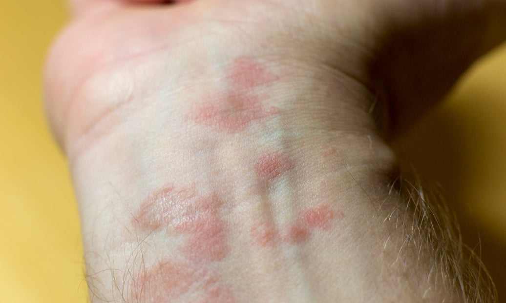 What Does Psoriasis Look Like When It Starts?