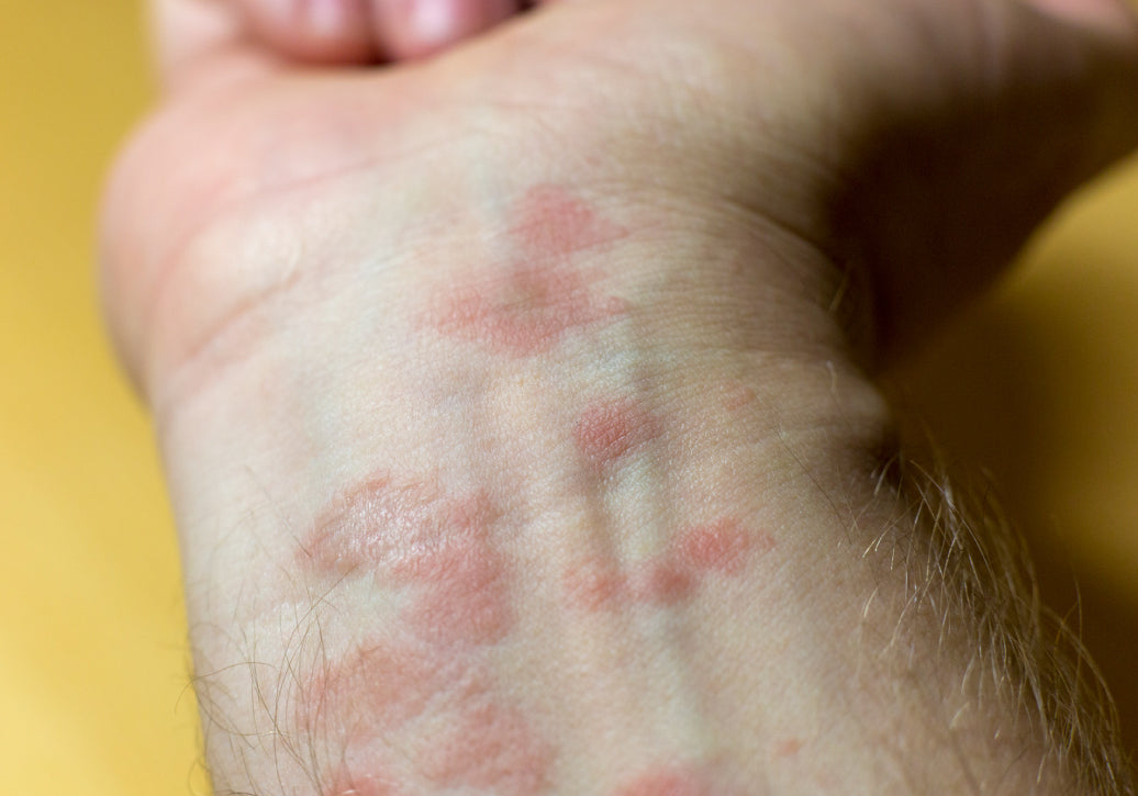What Does Psoriasis Look Like When It Starts?