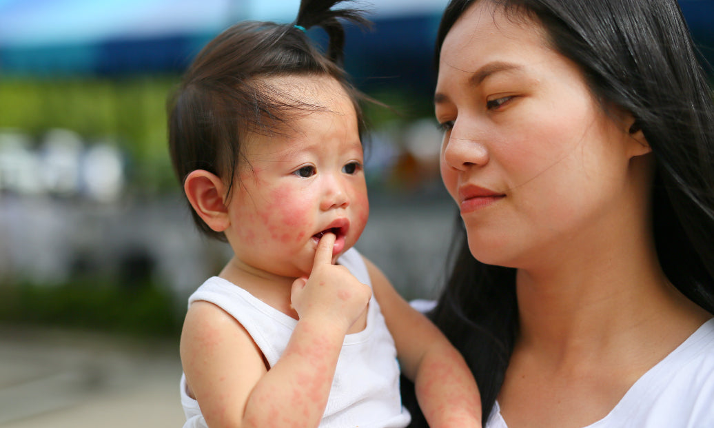 Mother holding child with eczema