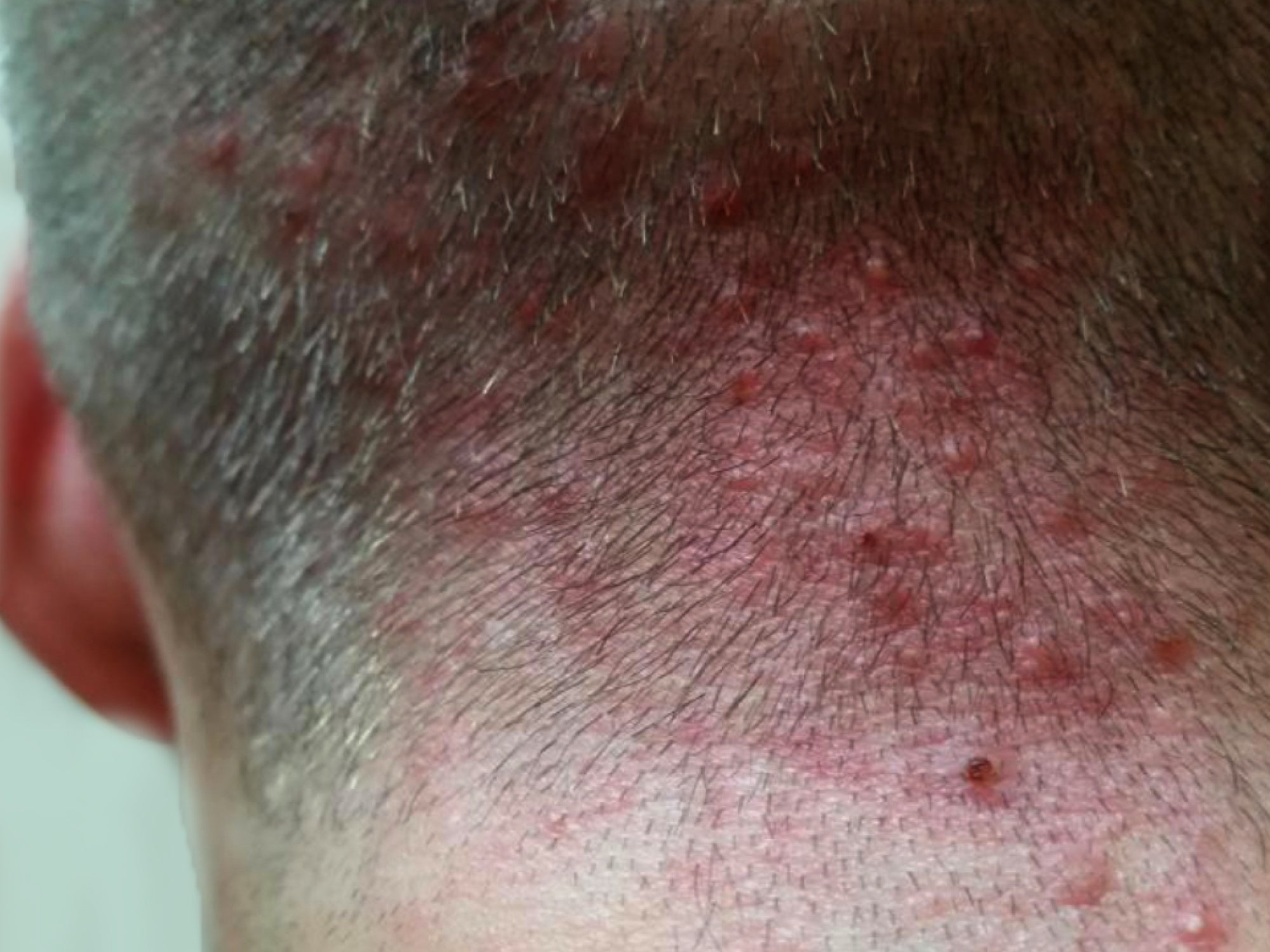 Neck And Head Sores