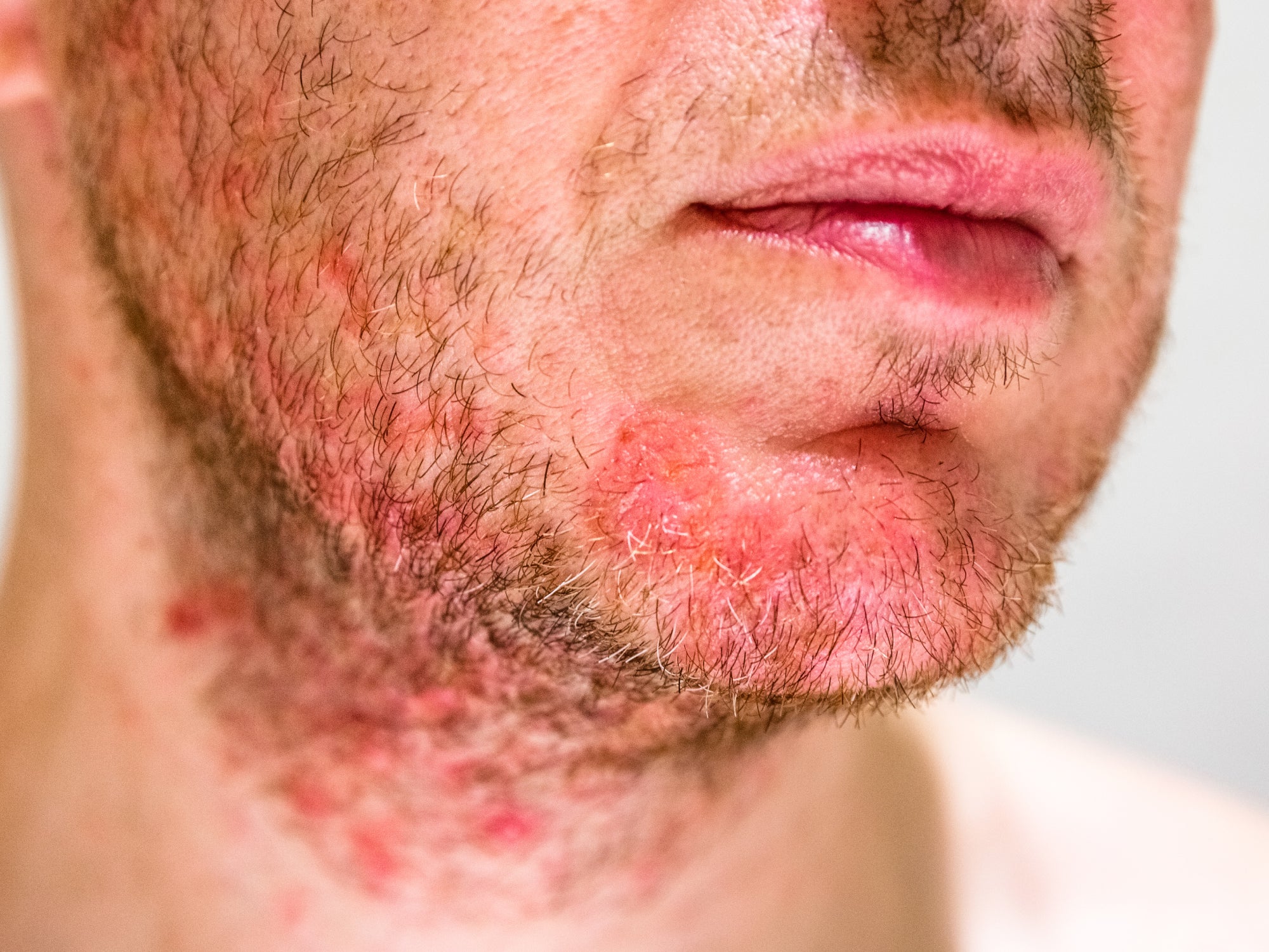 Seborrheic Dermatitis: Causes, Symptoms and Treatment