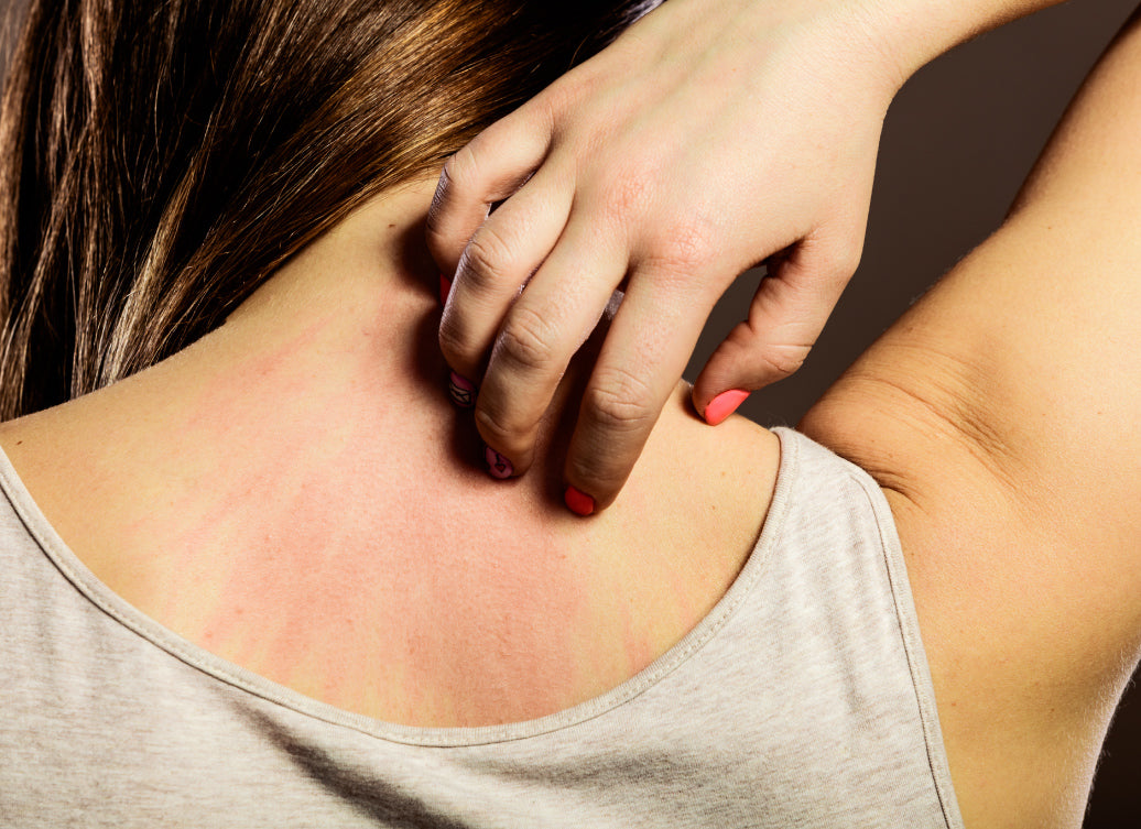 How Do You Treat Chlorine Rash?