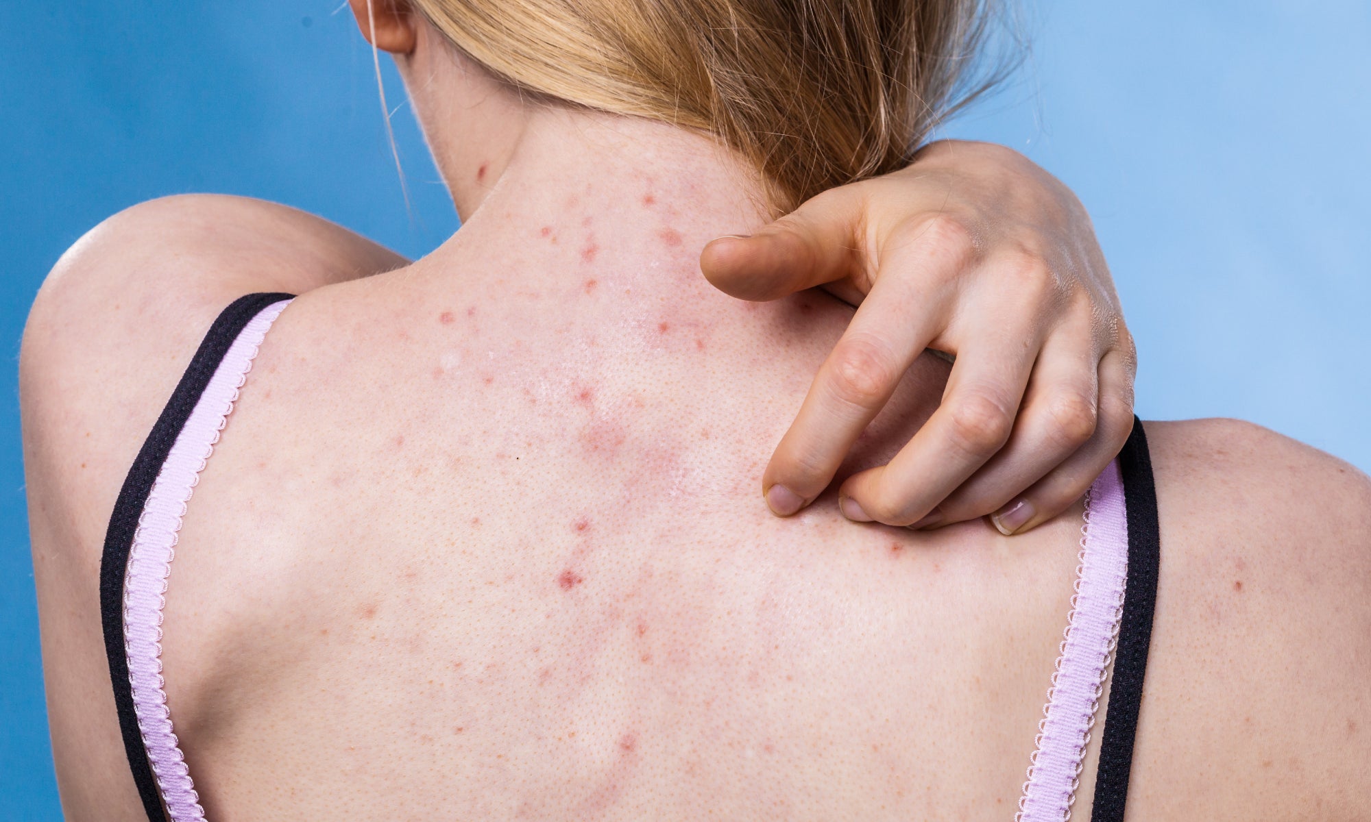 Can Acne Look Like A Rash?