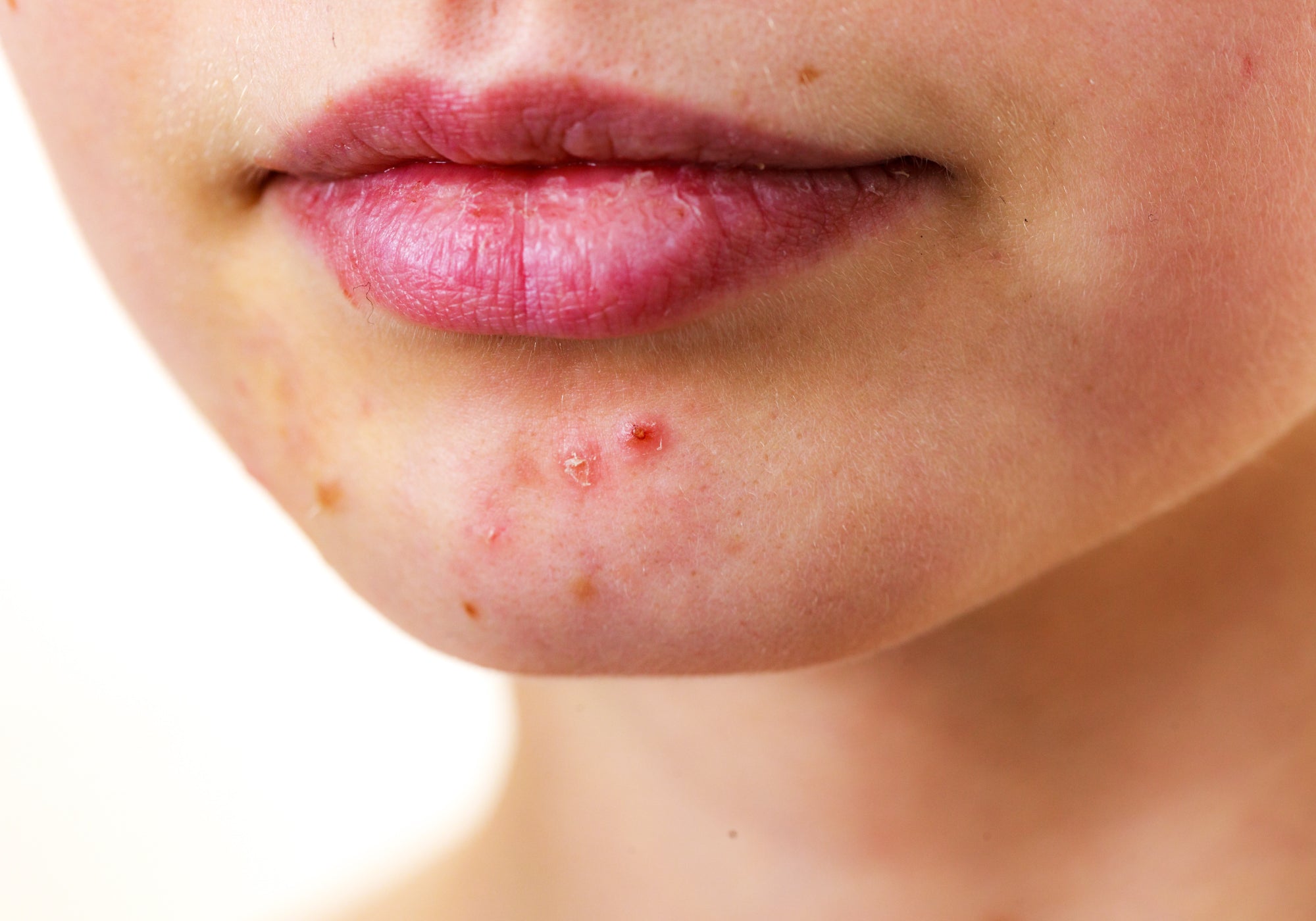 What Is It? Perioral Dermatitis Vs Acne