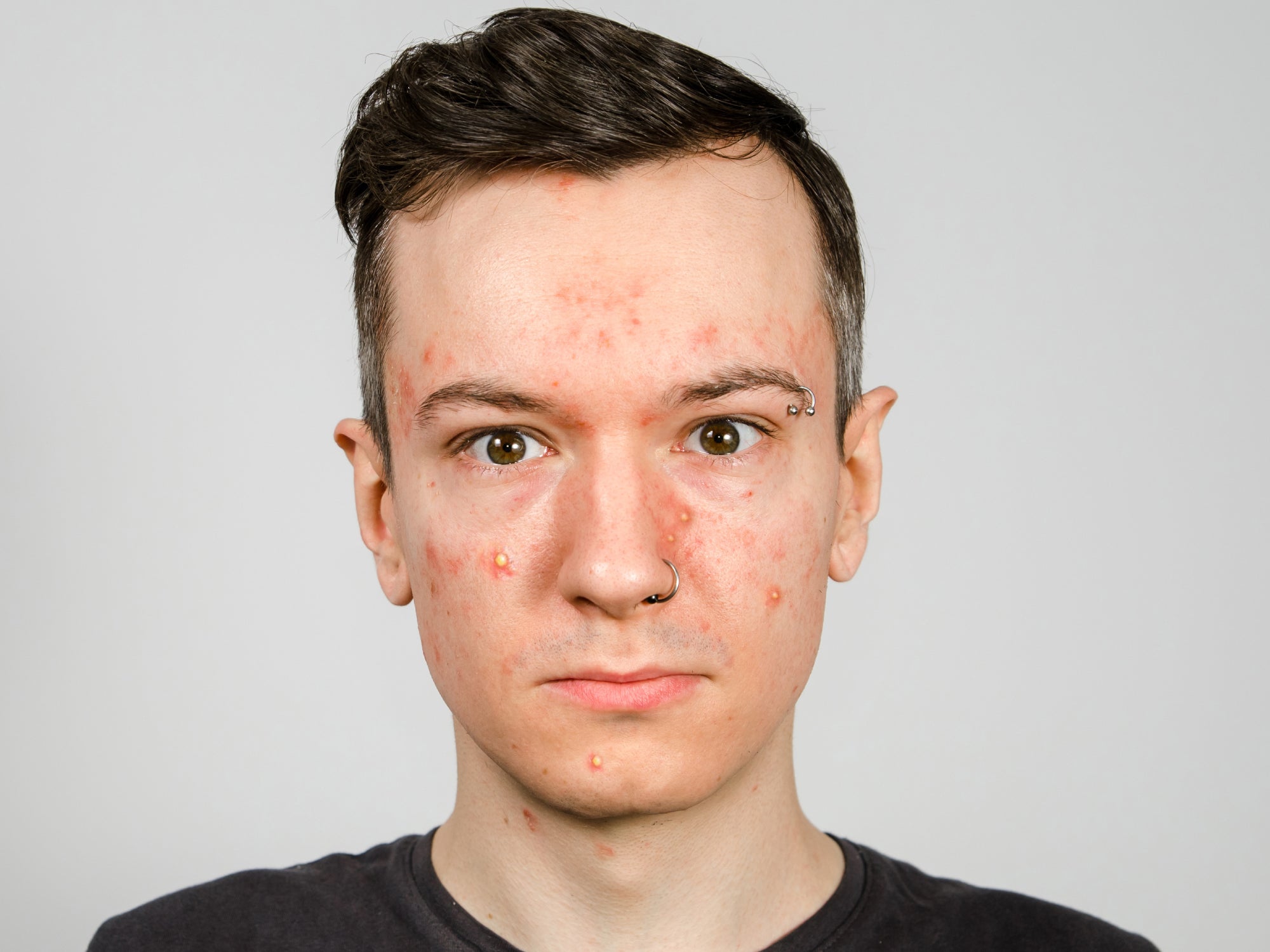 What Skin Infection Looks Like Acne?