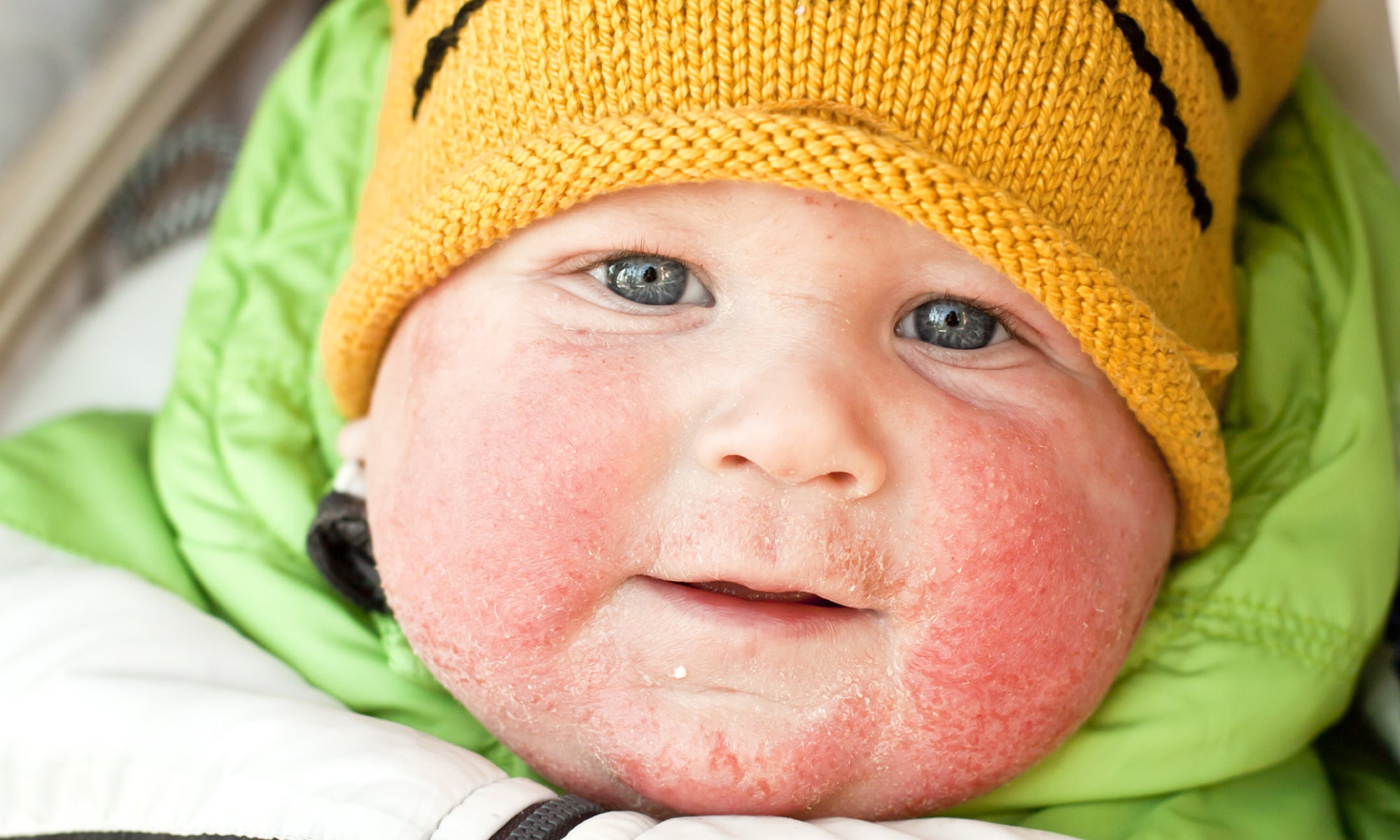 Does Baby Eczema Go Away?