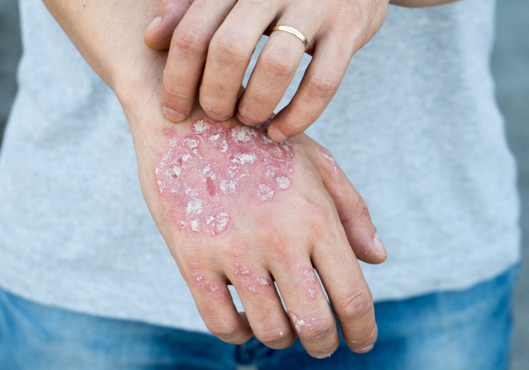 What Organs Can Be Affected By Psoriasis?