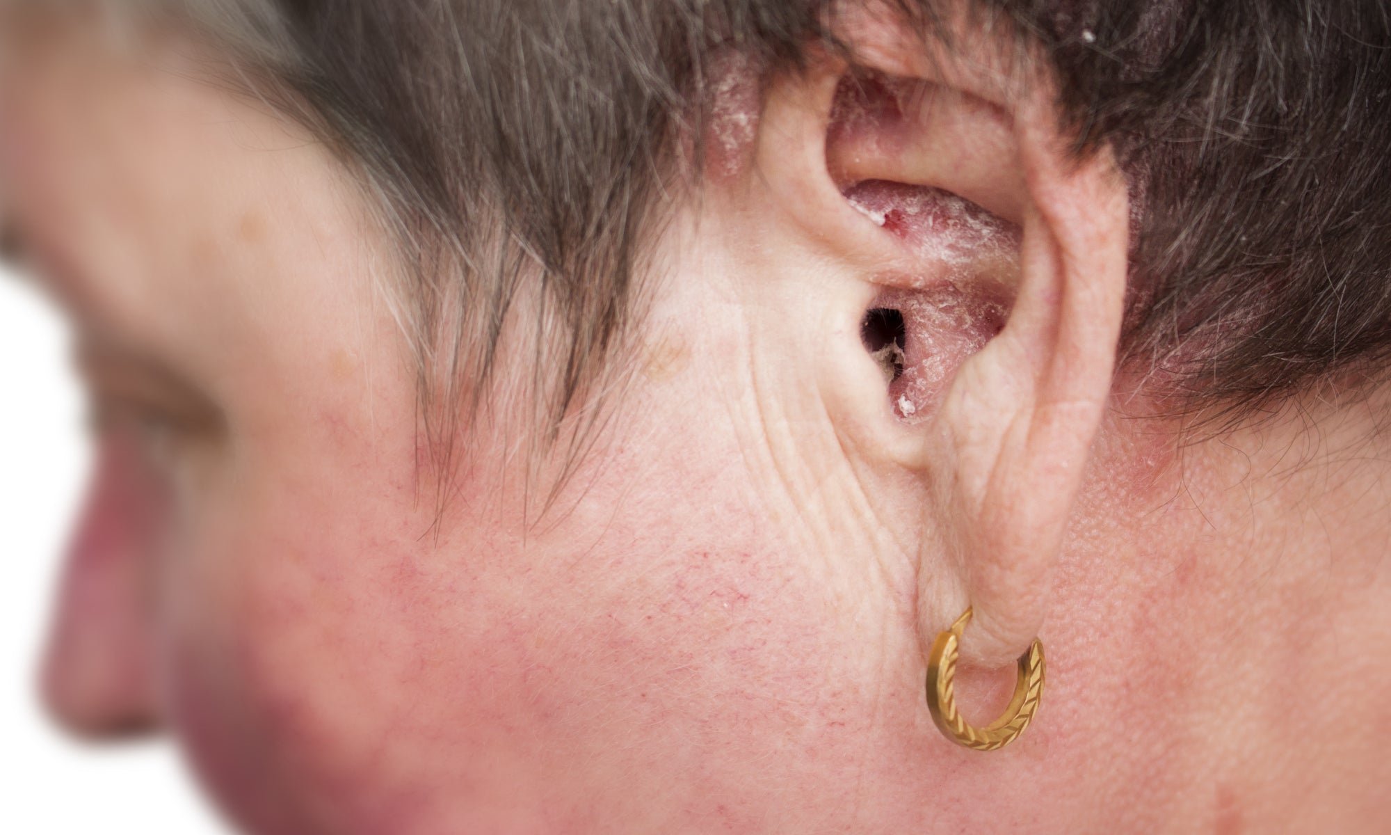 Can You Cure Aural Dermatitis/Ear Eczema?