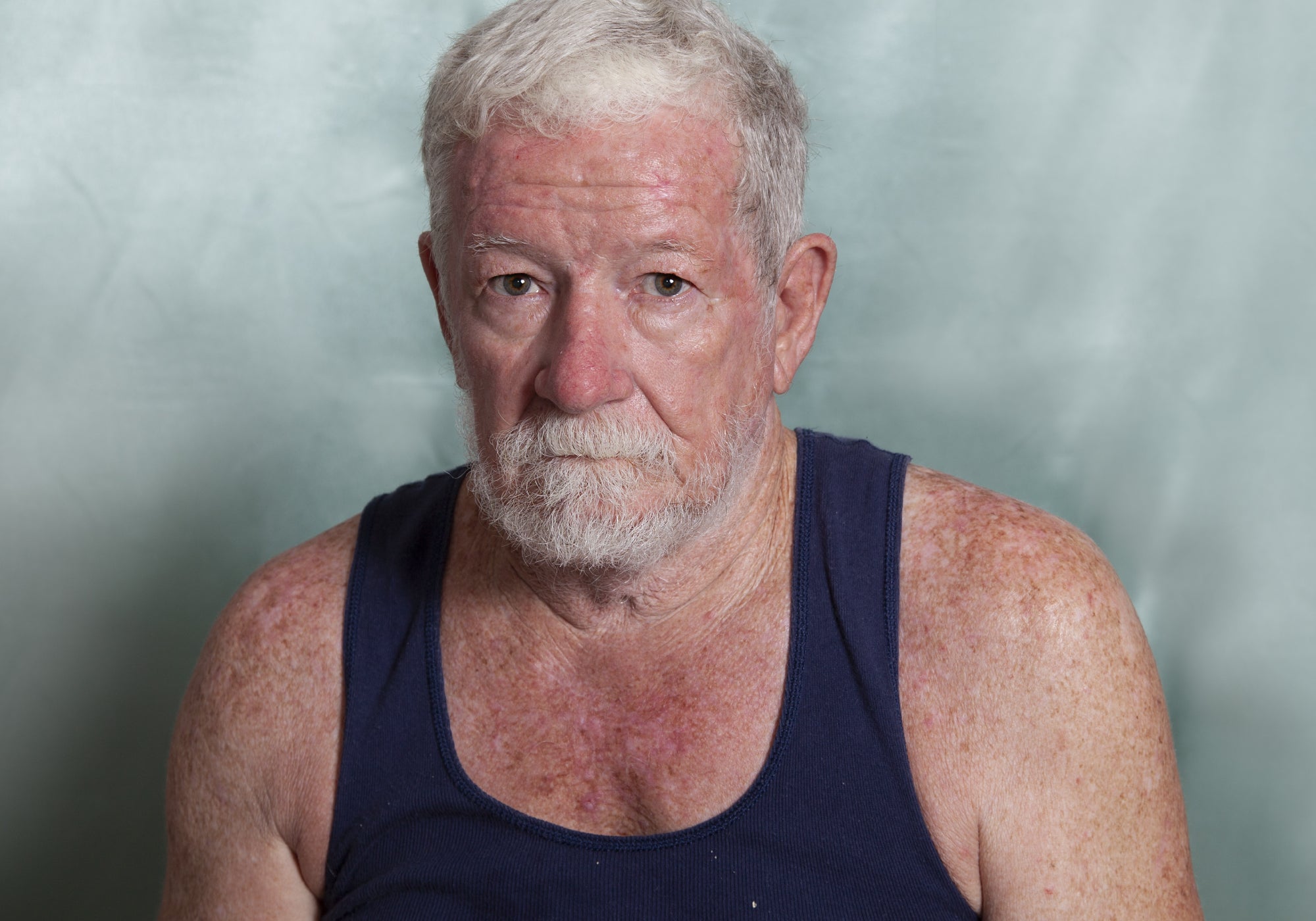 an example of actinic keratosis