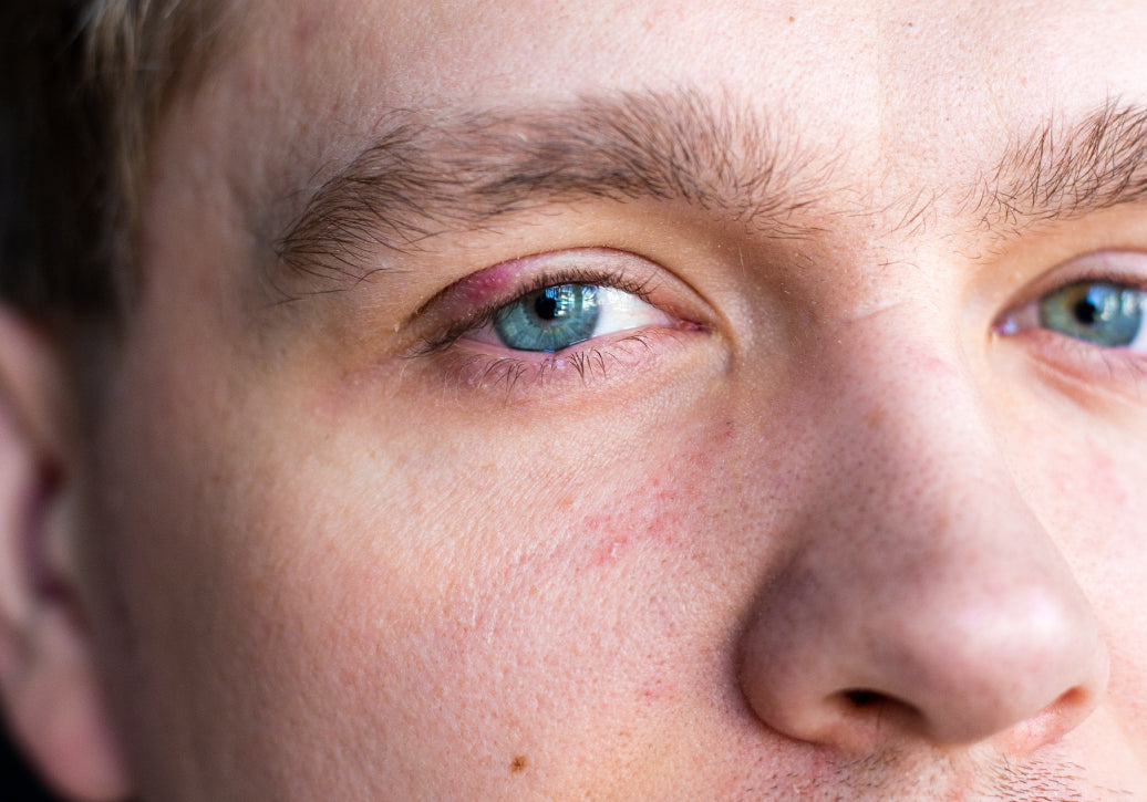 Blepharitis on one eye lid