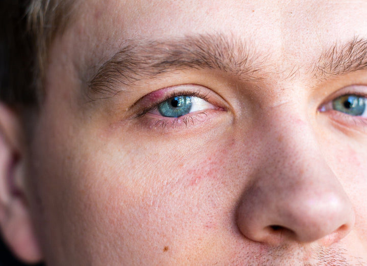 Blepharitis on one eye lid
