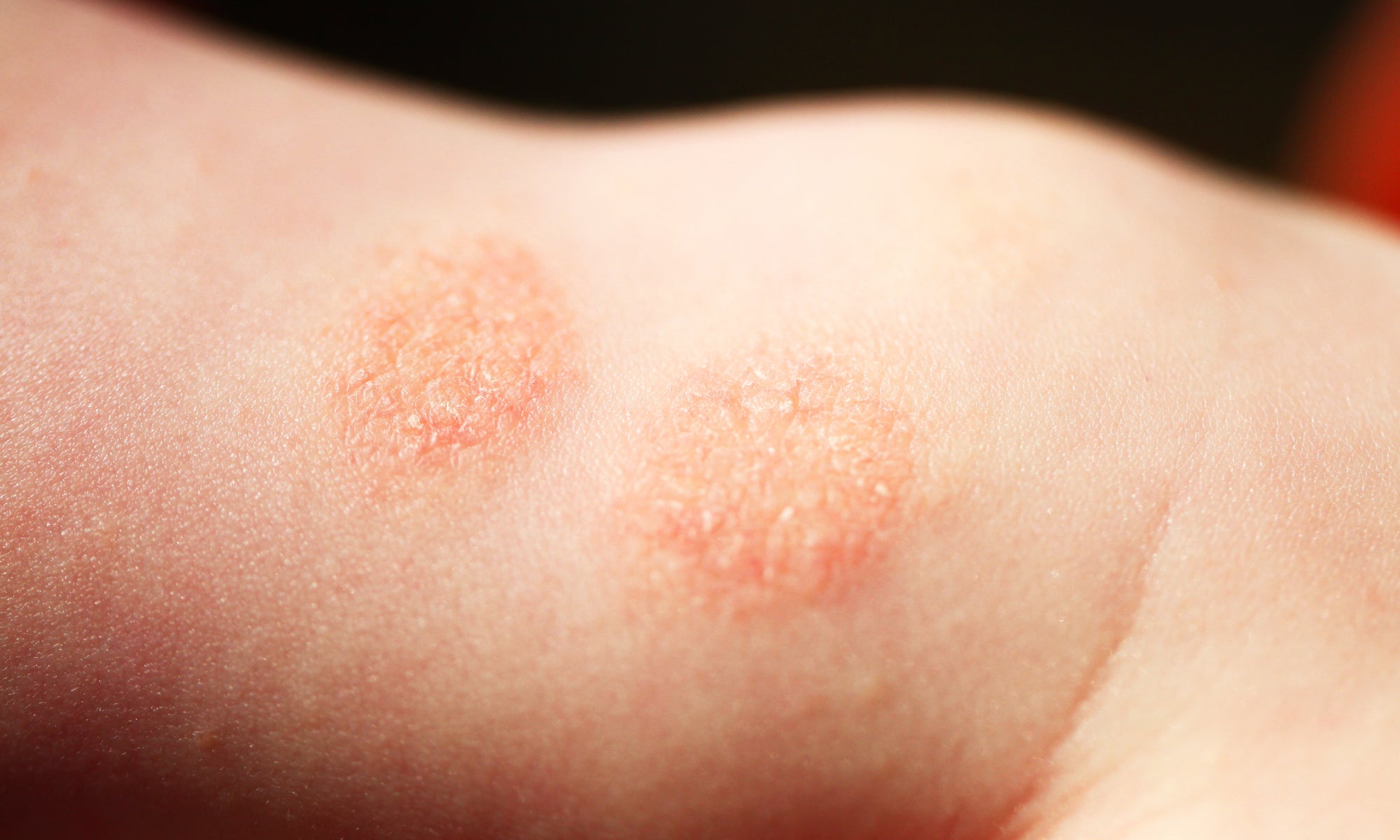 Discoid Eczema on the skin