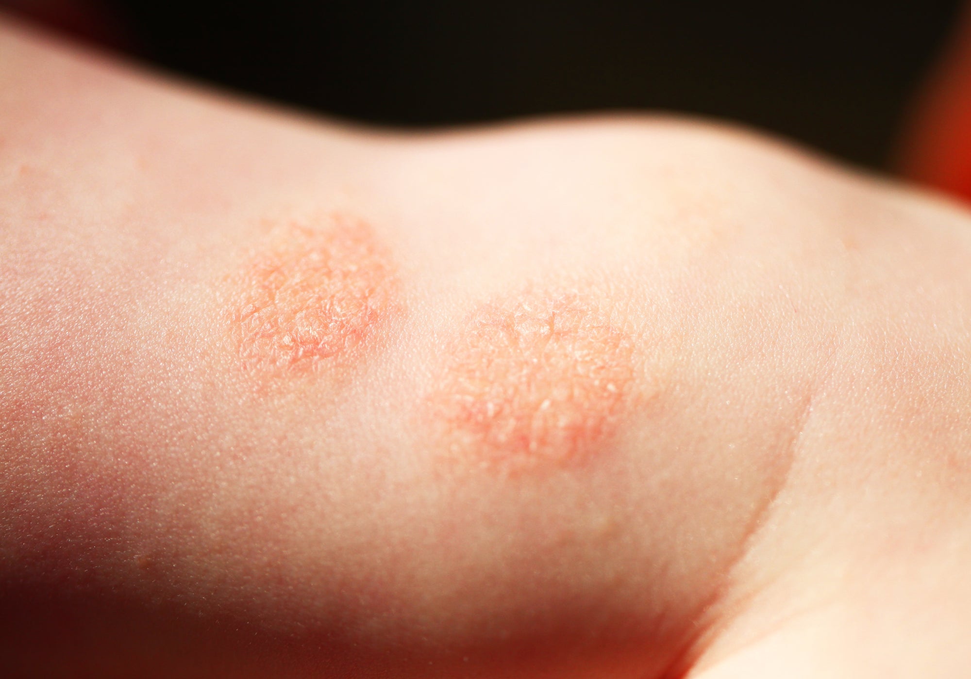 Discoid Eczema on the skin