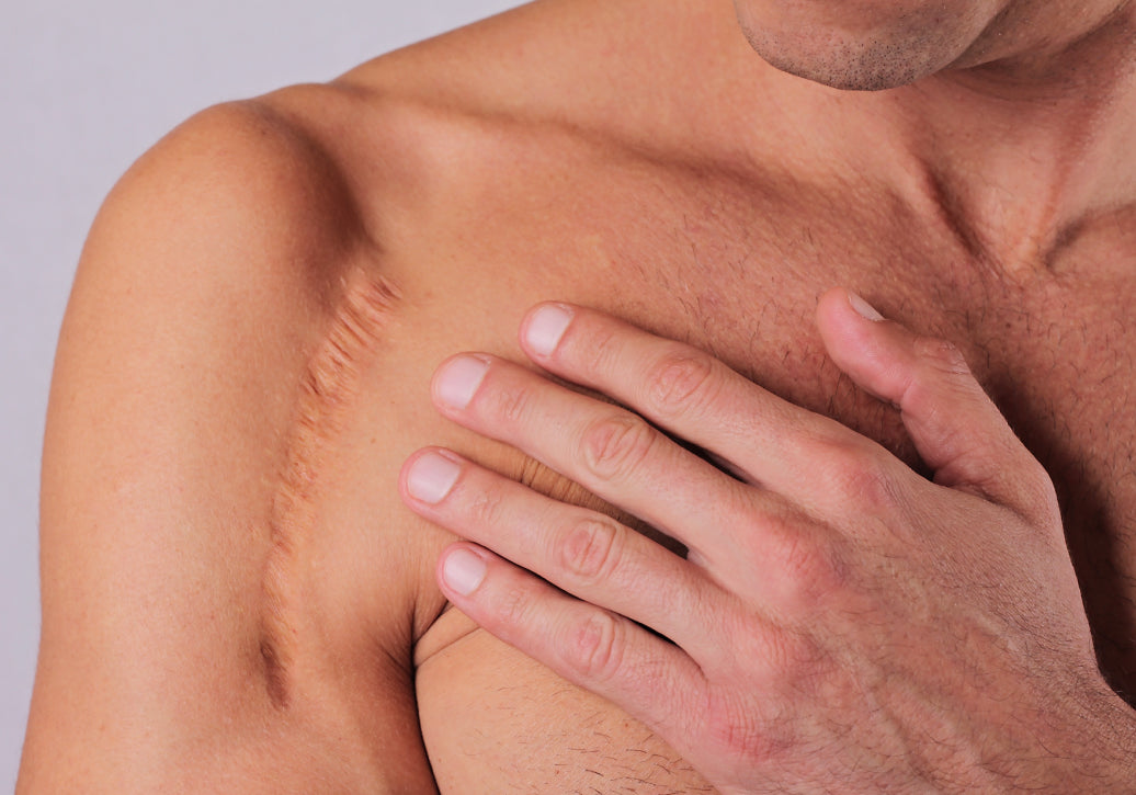 A scar on the inside of a shoulder